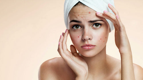 4 Consejos para prevenir granos